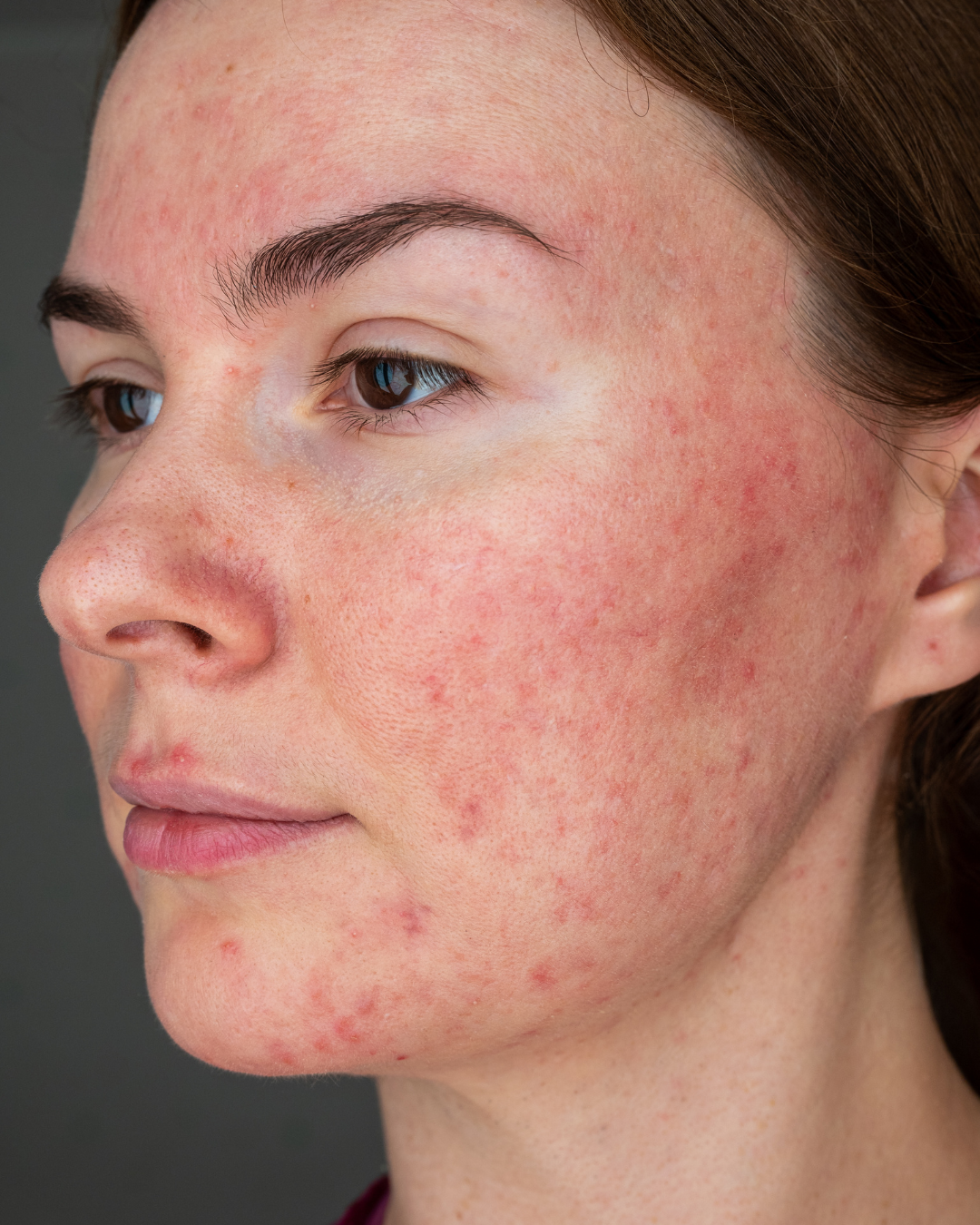 Opleiding ROSACEA voor huidprofessionals